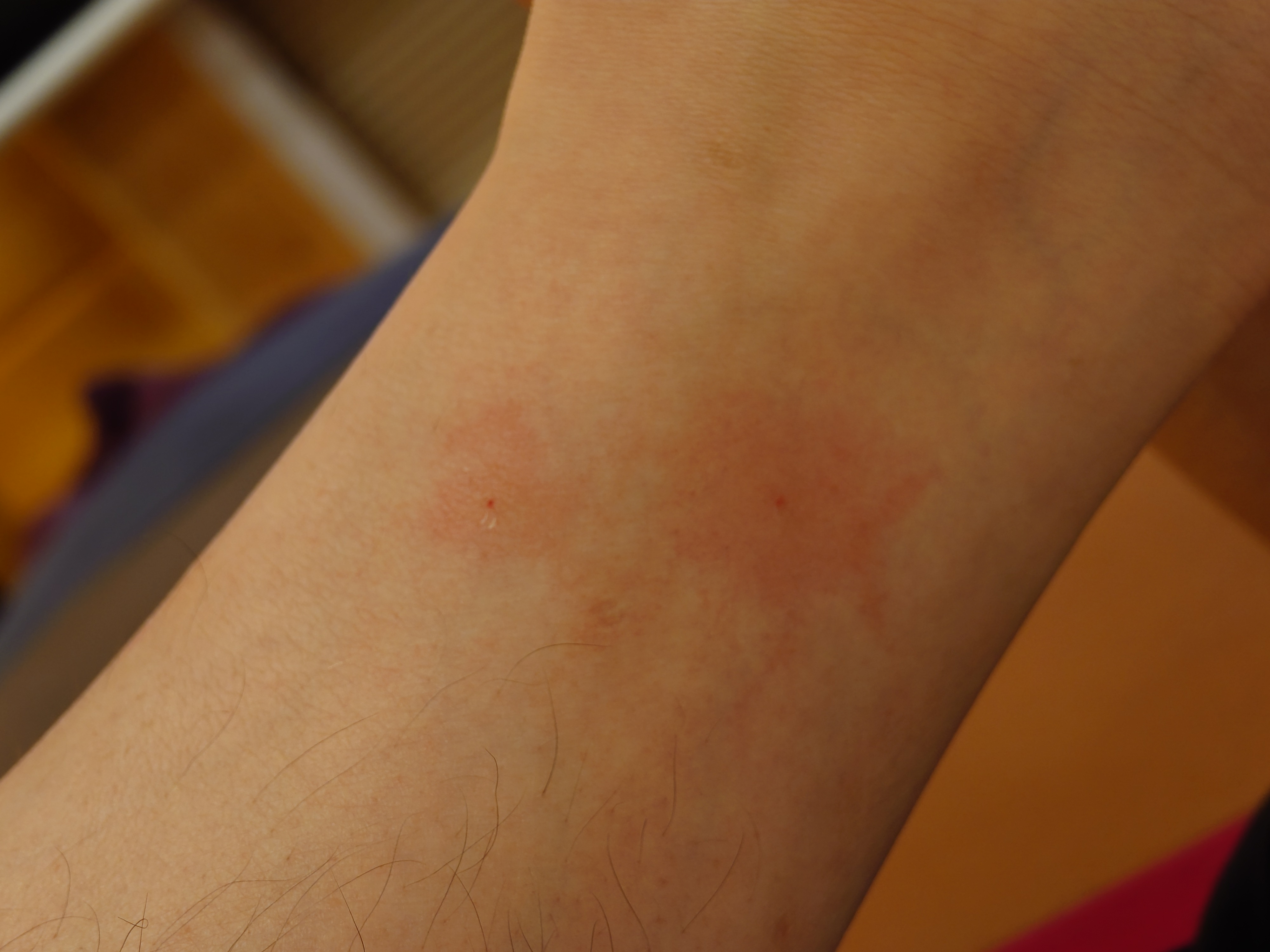 ブユに刺されて赤く腫れている段階